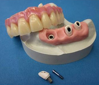 Dental Telescope Denture Telesope Crown Dental Prothesis, Laboratoire Dentaire Dentallabor,Dental