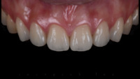more images of Telescope Crown | Chinese Digital Dental Lab