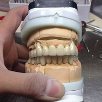 more images of Telescope Crown | Chinese Digital Dental Lab
