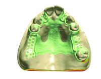 3D Laser Printed Metal Framework | China Digital Dental Lab