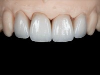 more images of Zirconia Dental Crown | Zirconia Dental Lab in China