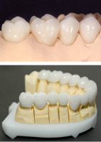IPS e.max® IPS E.max Veneer/Crown | Dental Lab Manufacturers, Suppliers
