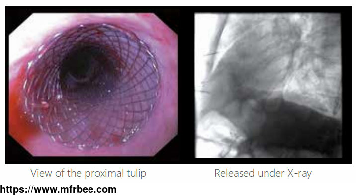 covered_esophageal_stents
