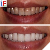 more images of Hot Dental Products Popular At Home Teeth Whitening Kit