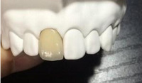 Dental Treatment Dental Metal Ceramic Crown Made  Dental Lab in