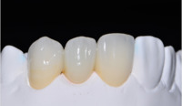 Dental Clip On Veneers, Snap On Veneers Smile Veneers Laboratoire Dentaire Dentallabor,Dental Lab