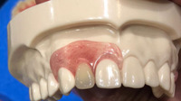 Pure titanium ceramic teeth, zirconia all porcelain teeth processing
