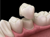 Adsorptive/INVISIBLE denture, movable/FIXED denture, metal/porcelain denture