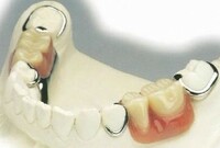 Titanium Denture Crown 3D Printing Denture Metal Titanium Teeth