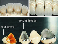 Captek Good metal metal and fake porcelain teeth