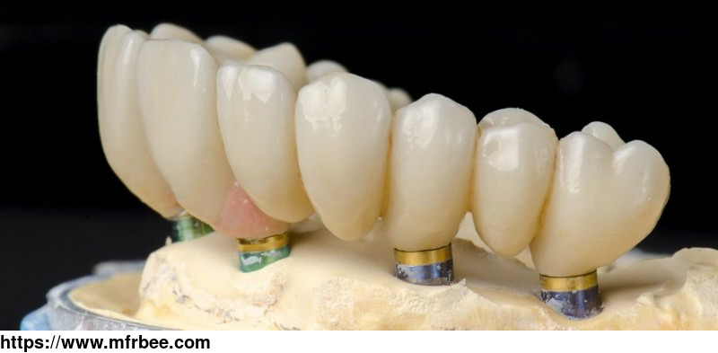 full_arch_screw_retained_implant_pfm_bridge_on_zimmer_implant_system