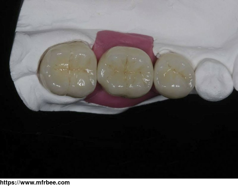 dental_implants_china_dental_lab_outsourcing
