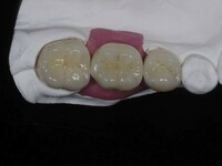Dental-Implants china dental lab outsourcing
