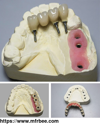 smart_1_screw_retained_low_cost_dental_all_on_four_implant_restoration_in_china