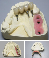 SMART 1 Screw Retained Low Cost Dental All-on-Four Implant Restoration in China
