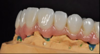 more images of Denture Over Implant Bars  China Dental Laboratory - China Digital Dental Lab
