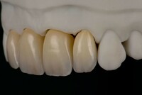 more images of Veneers w/E.max  FDA certificated Chinese dental lab looks for USA distributors
