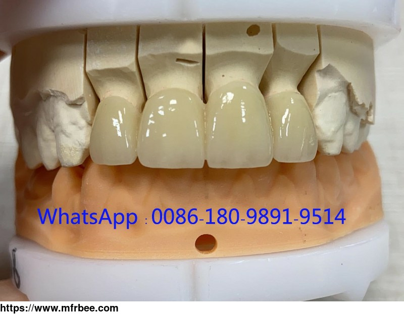 full_zirconia_restoration_fabricated_by_china_dental_labzirmax_key_features
