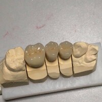 more images of IPS e.max® IPS E.max Veneer/Crown | Dental Lab Manufacturers, Suppliers