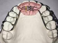 more images of Chian Clear Invisible Aligners, Clear Teeth Aligners