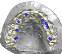 Skaitmeninis dantų modelio dizainas