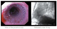 more images of Covered Esophageal Stents