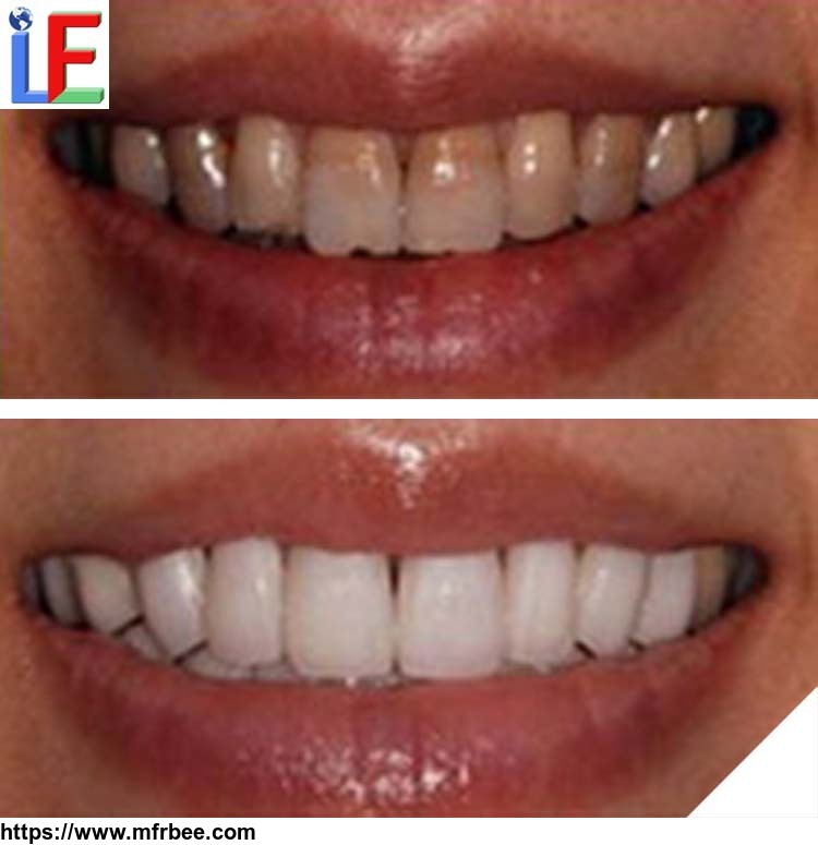 hot_dental_products_popular_at_home_teeth_whitening_kit