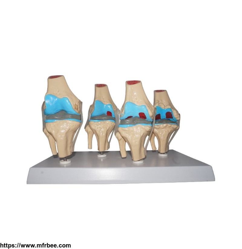 human_four_stage_diseased_knee_joint_model