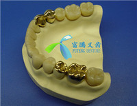 more images of High Noble yellow/white/semi-precious gold PFM restorations