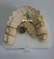 Porcelain bonded Metal Crown PFM  FuTeng dental lab outsourcing in China